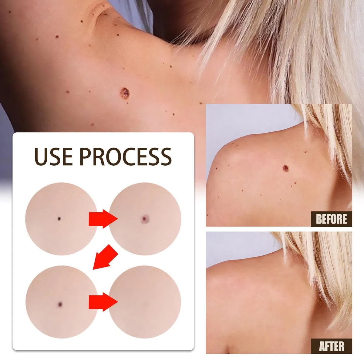 Crema Anti-acrocordón - Bálsamo Anti-verrugas | Removedor De Lunares Safe Remedy Para Piel Oscura, Lunares Elevados, Lunares Planos | Eliminador De Verrugas Anti Verrugas
