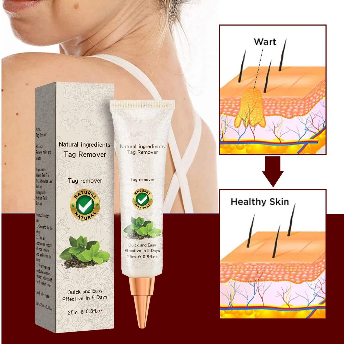 Crema Anti-acrocordón - Bálsamo Anti-verrugas | Removedor De Lunares Safe Remedy Para Piel Oscura, Lunares Elevados, Lunares Planos | Eliminador De Verrugas Anti Verrugas