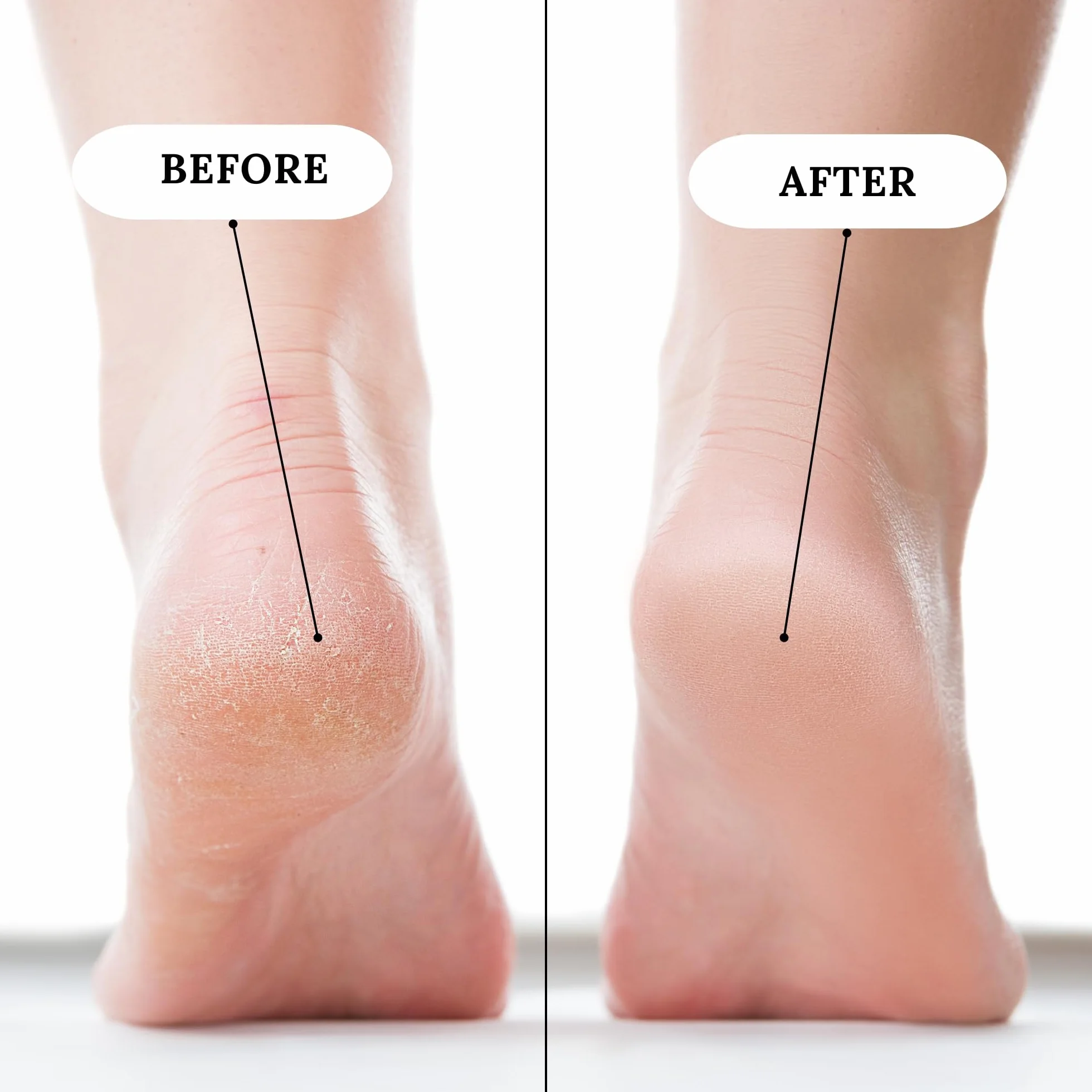 SNB Professional Callus Removal Spray 110 ml con urea, aceite de lavanda, glicerina, eucalipto y manzanilla, composición 91% natural, eliminador de callos de los pies, para piel muy seca