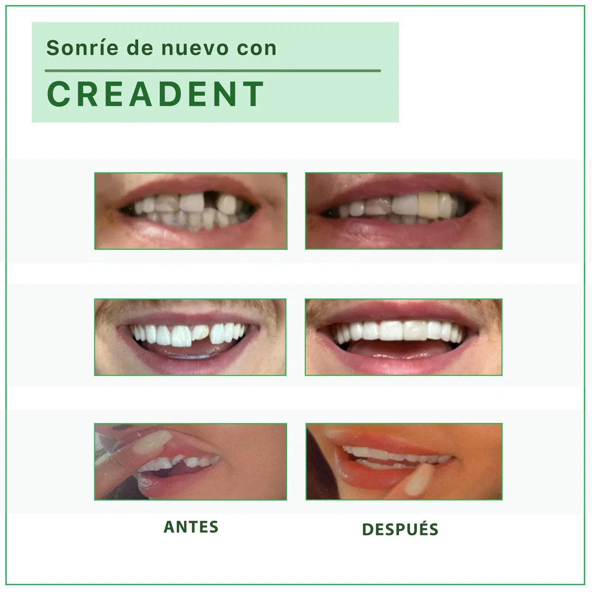 CREADENT Kit para remplazar un diente faltante por un diente cosmético provisional.CREADENT Blanco