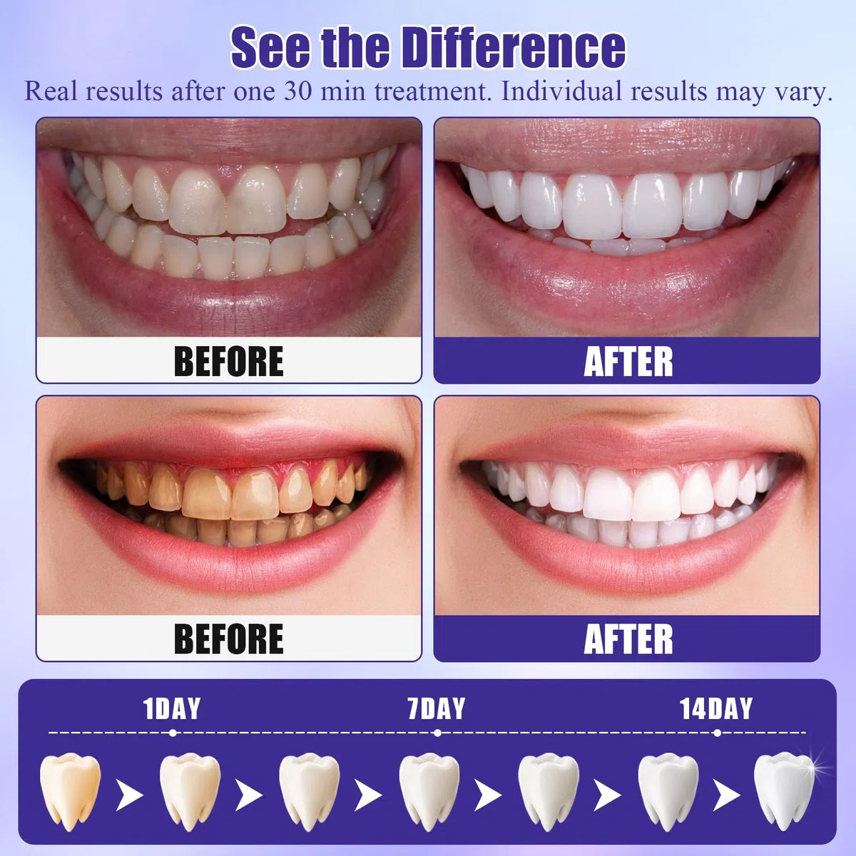 28 Pares Tiras Blanqueadoras Moradas, Blanqueador Dental En Casa, Tiras Blanqueadoras Para Dientes MáS Blancos, Refresca RespiracióN, Resultados RáPidos