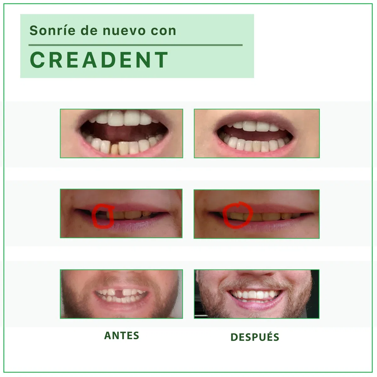 CREADENT Kit para remplazar un diente faltante por un diente cosmético provisional.CREADENT Blanco